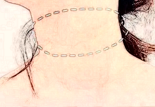 泉州嗨體去頸紋多少錢?泉州嗨體去頸紋哪家醫(yī)院好