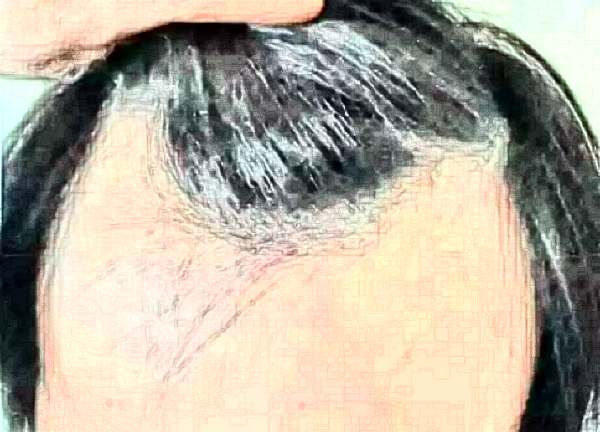 大連發(fā)際線種植費(fèi)用要多少?大連發(fā)際線種植醫(yī)院推薦