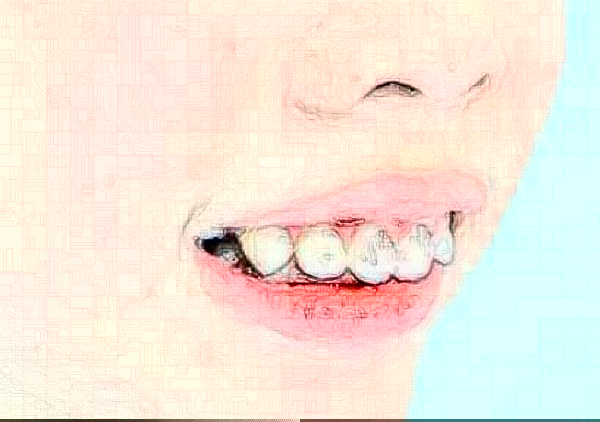 懷化地包天矯正多少錢?地包天矯正醫(yī)生排名