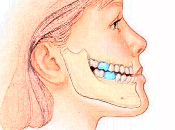 懷化地包天矯正多少錢?地包天矯正醫(yī)生排名