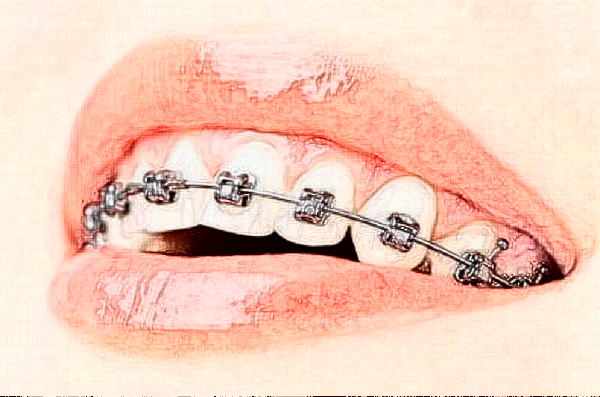 淮北頜面正畸價格表?頜面正畸哪個醫(yī)院好