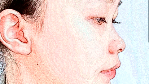 鼻翼縮小價格表_鼻翼縮小術后還會反彈嗎