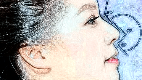 鼻翼縮小價格表_鼻翼縮小術后還會反彈嗎