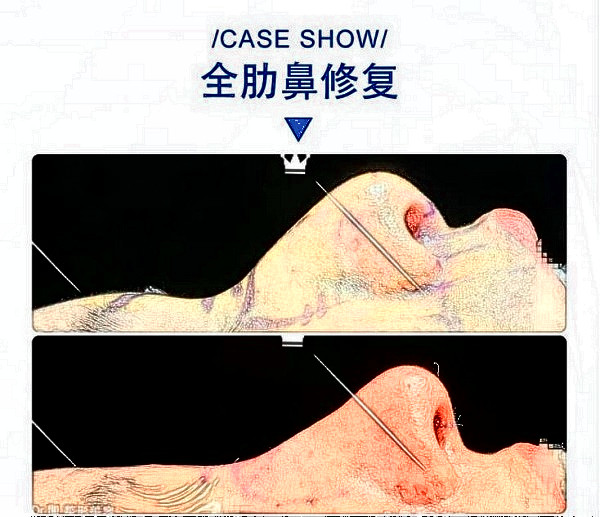 華西醫(yī)院卿勇全肋鼻修復(fù)案例圖片(來源知乎)