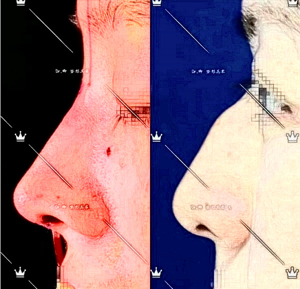 華西醫(yī)院卿勇駝峰鼻矯正案例圖片(來源知乎)