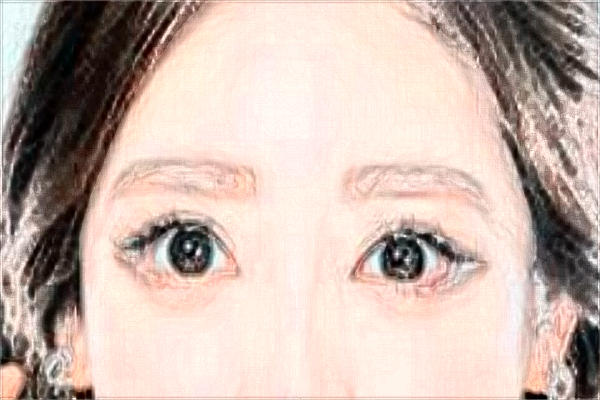 割雙眼皮和埋線哪個好?割雙眼皮和去眼袋哪個風(fēng)險大?