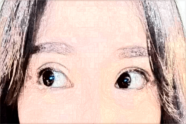 割雙眼皮幾天拆線佳?割雙眼皮幾天可以熱敷?