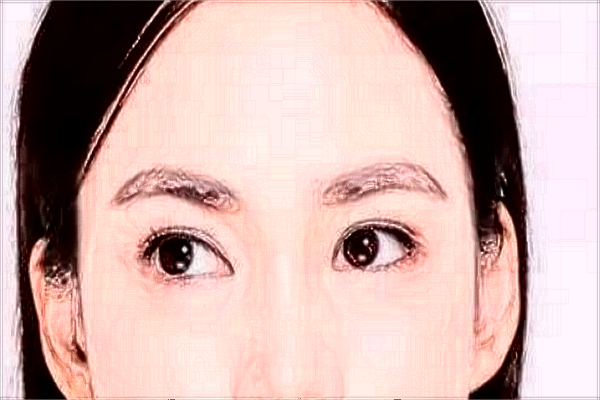 割雙眼皮需要多少錢一次?割雙眼皮需要恢復(fù)多長時間?