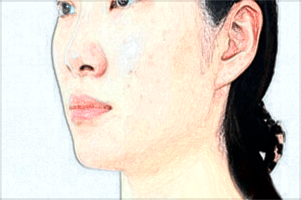 耳垂矯正價格表_垂耳矯正后還會垂下來嗎