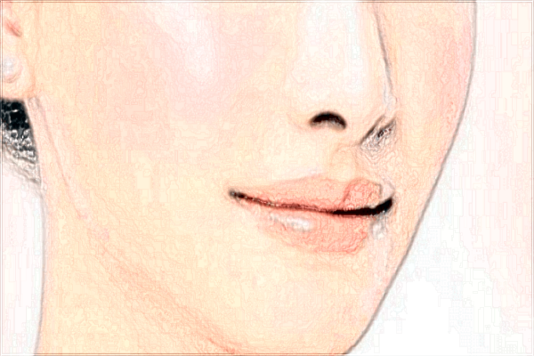 2024鞍鼻矯正價格表_鞍鼻矯正術(shù)需要住院嗎