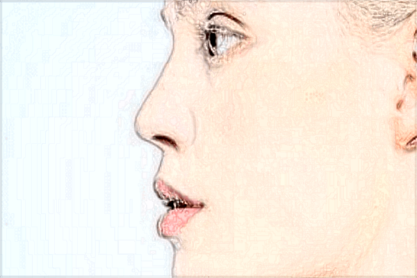 唇裂修復(fù)價(jià)格表_唇裂修復(fù)術(shù)的佳年齡