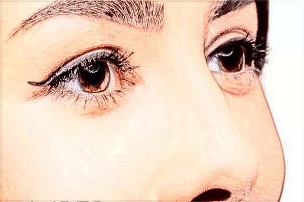 割雙眼皮有哪些危害性?割雙眼皮有什么危害或者后遺癥？