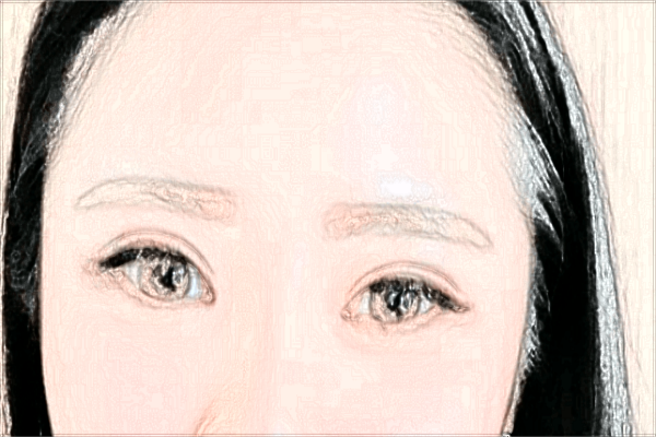 割雙眼皮需要住院?jiǎn)?割雙眼皮需要打麻藥嗎?