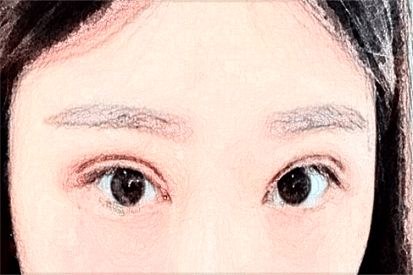 割雙眼皮打麻藥疼嗎?割雙眼皮打麻藥打哪里?