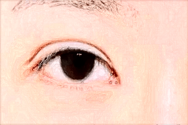 2024北京同仁醫(yī)院做雙眼皮價格表(價目表)怎么樣