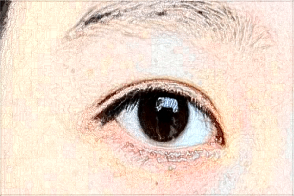 北京同仁醫(yī)院做眼內(nèi)翻手術(shù)怎么樣?眼內(nèi)翻手術(shù)多久恢復(fù)