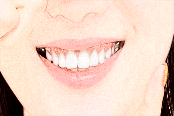 2024義烏牙齒矯正價(jià)目表_牙齒矯正的步驟和流程