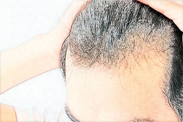 2024北京碧蓮盛植發(fā)價(jià)格表(價(jià)目表)搶先看