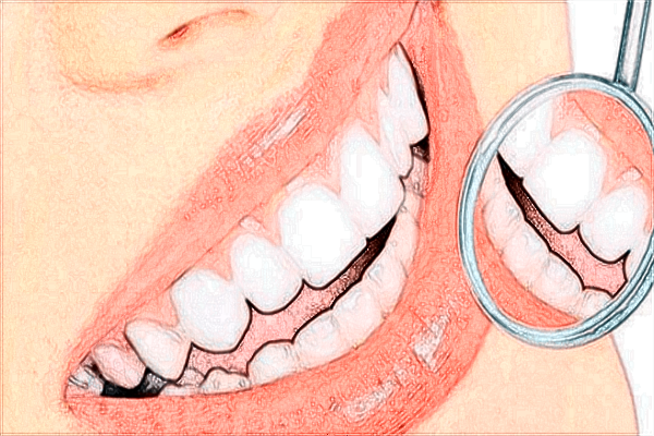 2024煙臺洛神種植牙價目表_種植牙是什么材料做的