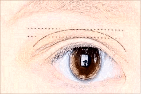 北京蒂凡妮開眼角怎么樣?開眼角多久能恢復好