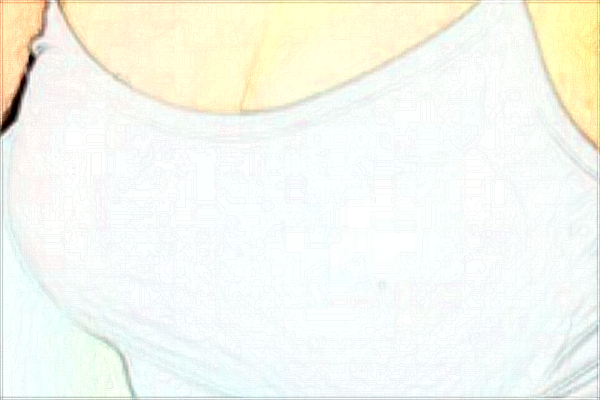 北京協和醫(yī)院隆胸技術如何【隆胸案例】