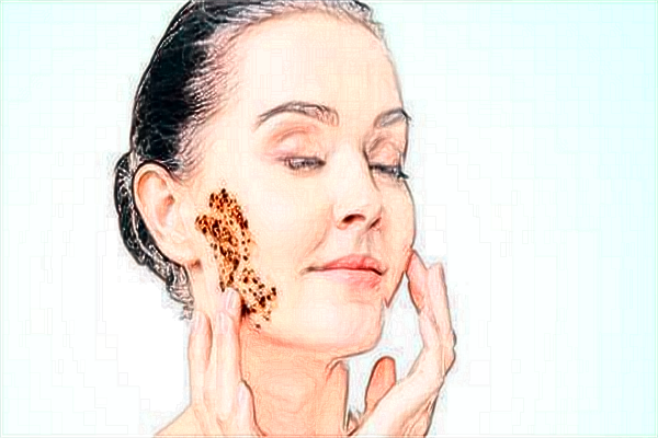 吉林大學(xué)第二醫(yī)院祛痣掛什么科?祛痣后的注意事項(xiàng)