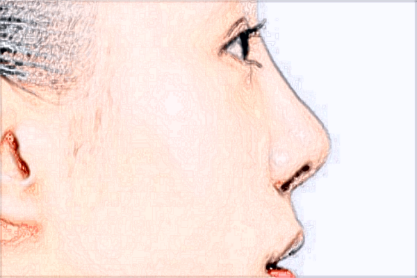 鄭大一附院祛痘價格?激光祛痘印好不好