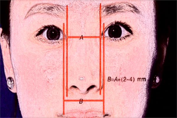 2024廣州海峽脂肪填充價格表(價目表)一覽