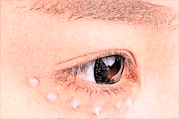 河北哪里做雙眼皮好?全切雙眼皮怎么恢復快