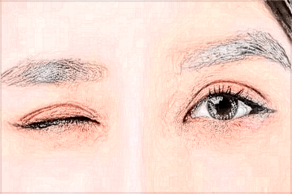 長(zhǎng)沙梵童整形醫(yī)院怎么樣?附割雙眼皮案例