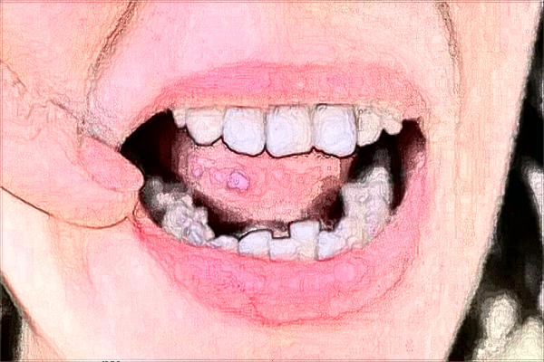 2024-2024齙牙矯正價(jià)目表公布_齙牙矯正的佳年齡是什么時(shí)候