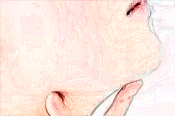 交大二院墊下巴怎么樣【附墊下巴案例】