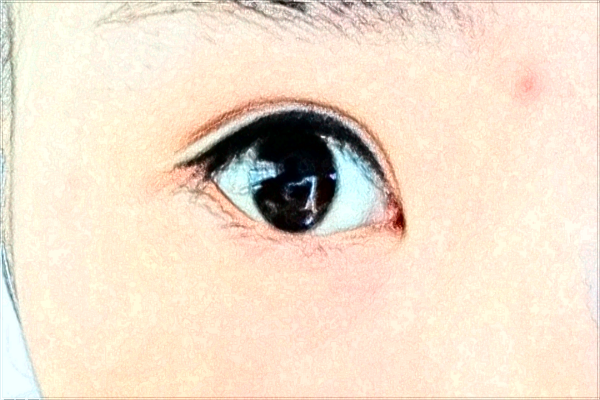 北京麗都開眼角哪個(gè)醫(yī)生好【開眼角案例】