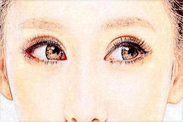 北京麗都開眼角哪個(gè)醫(yī)生好【開眼角案例】