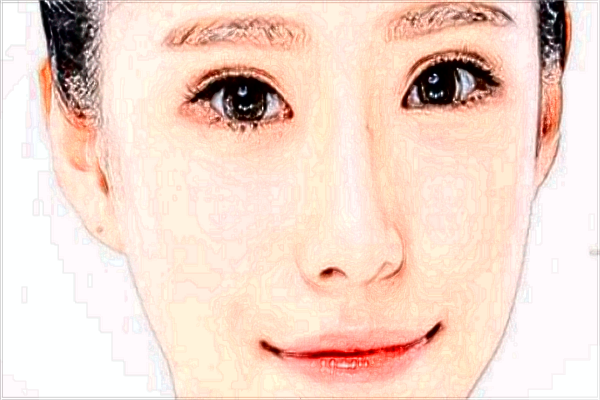 玻尿酸豐面頰多少錢?玻尿酸豐面頰需要幾支?