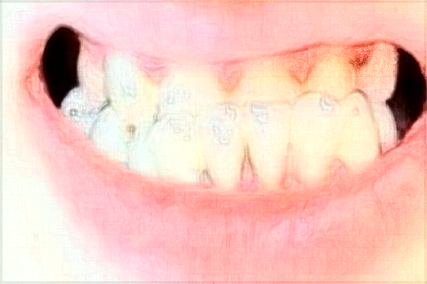 2024北京大學(xué)第三醫(yī)院矯正牙齒價(jià)格怎么樣