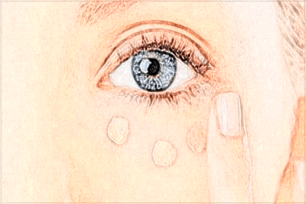 北京二院去眼袋怎么樣?2024去眼袋收費價格