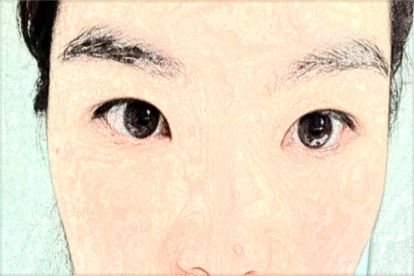 2024北京潤(rùn)美玉之光硅膠隆鼻價(jià)格表_硅膠隆鼻可以維持多少年