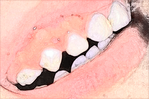 2024浙二院牙齒矯正怎么樣?浙二院牙齒矯正價格
