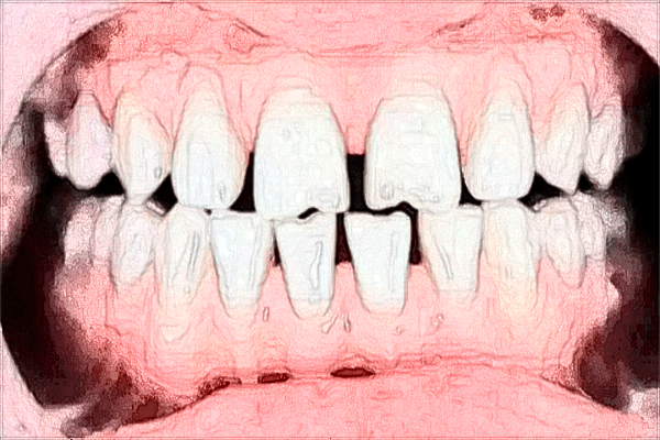 北京大學(xué)口腔醫(yī)院美白牙齒怎么樣_哪位醫(yī)生做的比較好