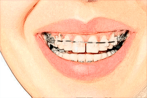 北京大學(xué)口腔醫(yī)院美白牙齒怎么樣_哪位醫(yī)生做的比較好