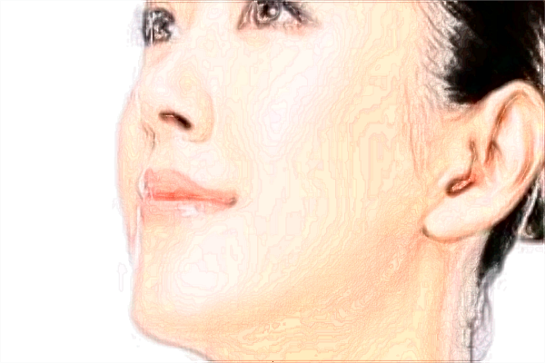 玻尿酸豐面頰幾天好看?玻尿酸豐面頰要做多久?