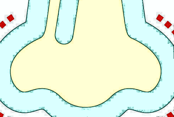 膨體隆鼻可以維持多少年?膨體隆鼻可以取出來嗎?