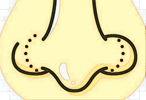 膨體隆鼻有什么后遺癥?膨體隆鼻有風險嗎?