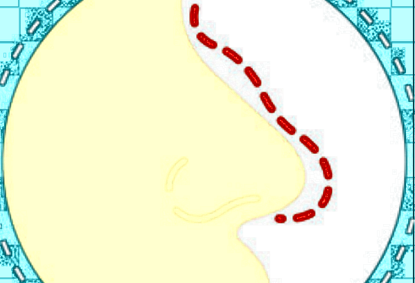 膨體隆鼻要多長時間?膨體隆鼻要住院嗎?