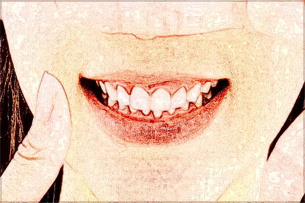 四川省人民醫(yī)院拔智齒多少錢【拔智齒案例】