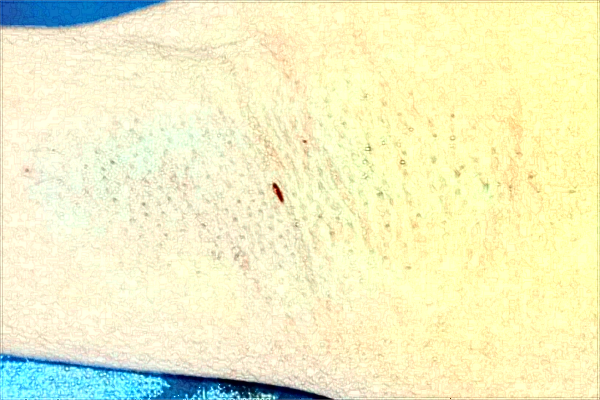 南京市中醫(yī)院激光狐臭做的好嗎？需要多少錢