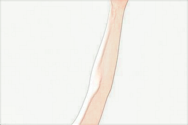 四川省人民醫(yī)院去疤痕價目表(價格表)怎么樣