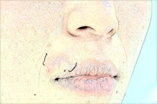 2024漳州175醫(yī)院激光點痣多少錢?激光點痣多久能恢復