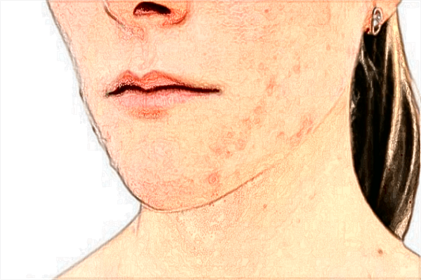 福州總醫(yī)院激光祛斑怎么樣?2024激光祛斑收費價格